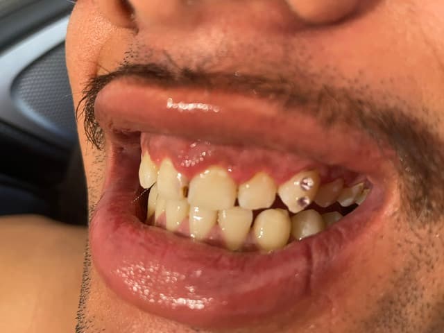 Close-up of a person's mouth featuring two small, sparkling gems attached to an upper tooth.