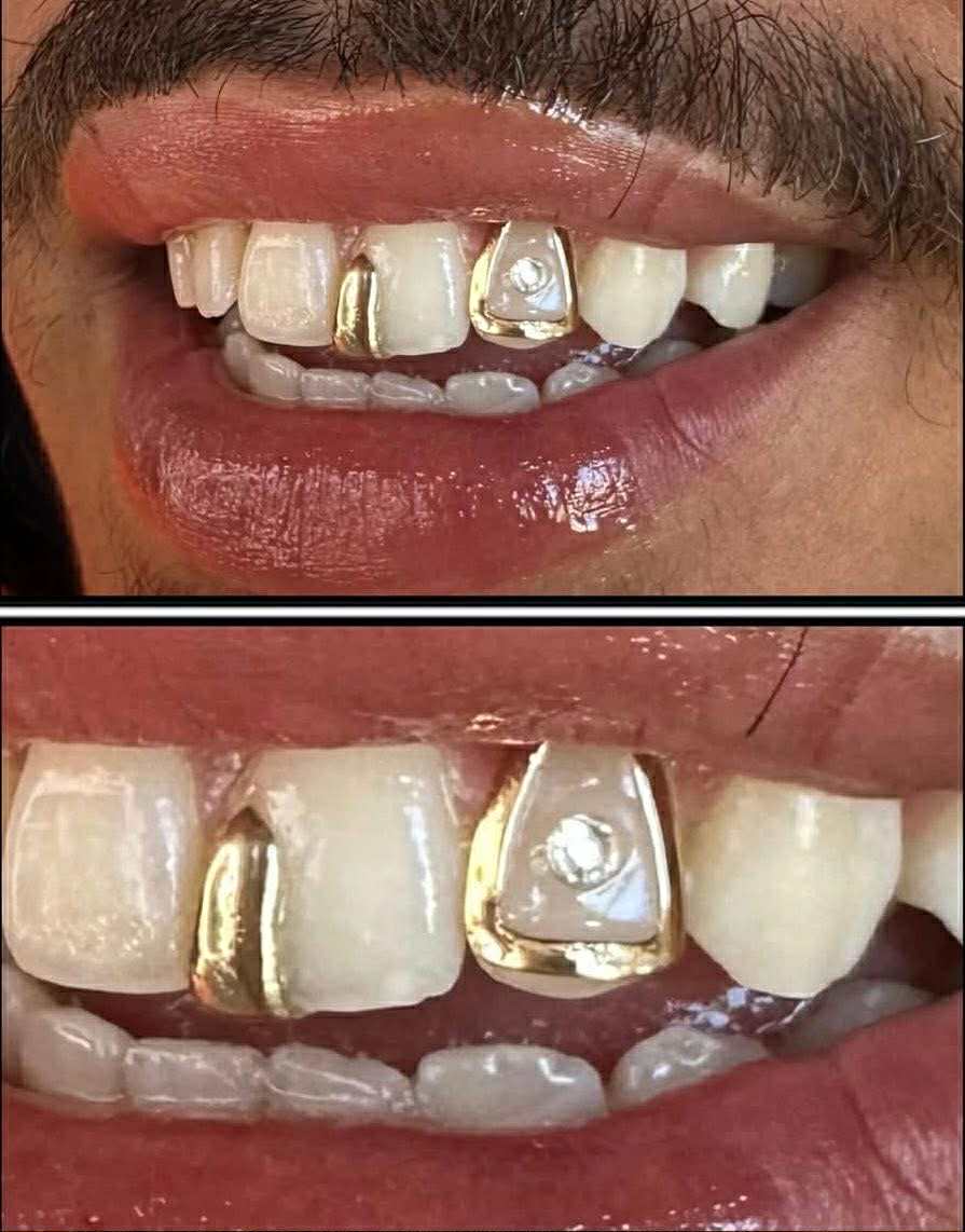 Close-up of a person's smile featuring gold tooth jewelry and a small inset diamond.