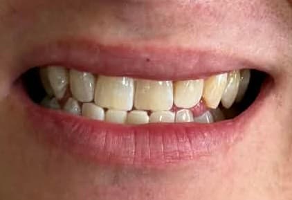 Close-up of a person's smile showing slightly yellowed teeth and pink lips.